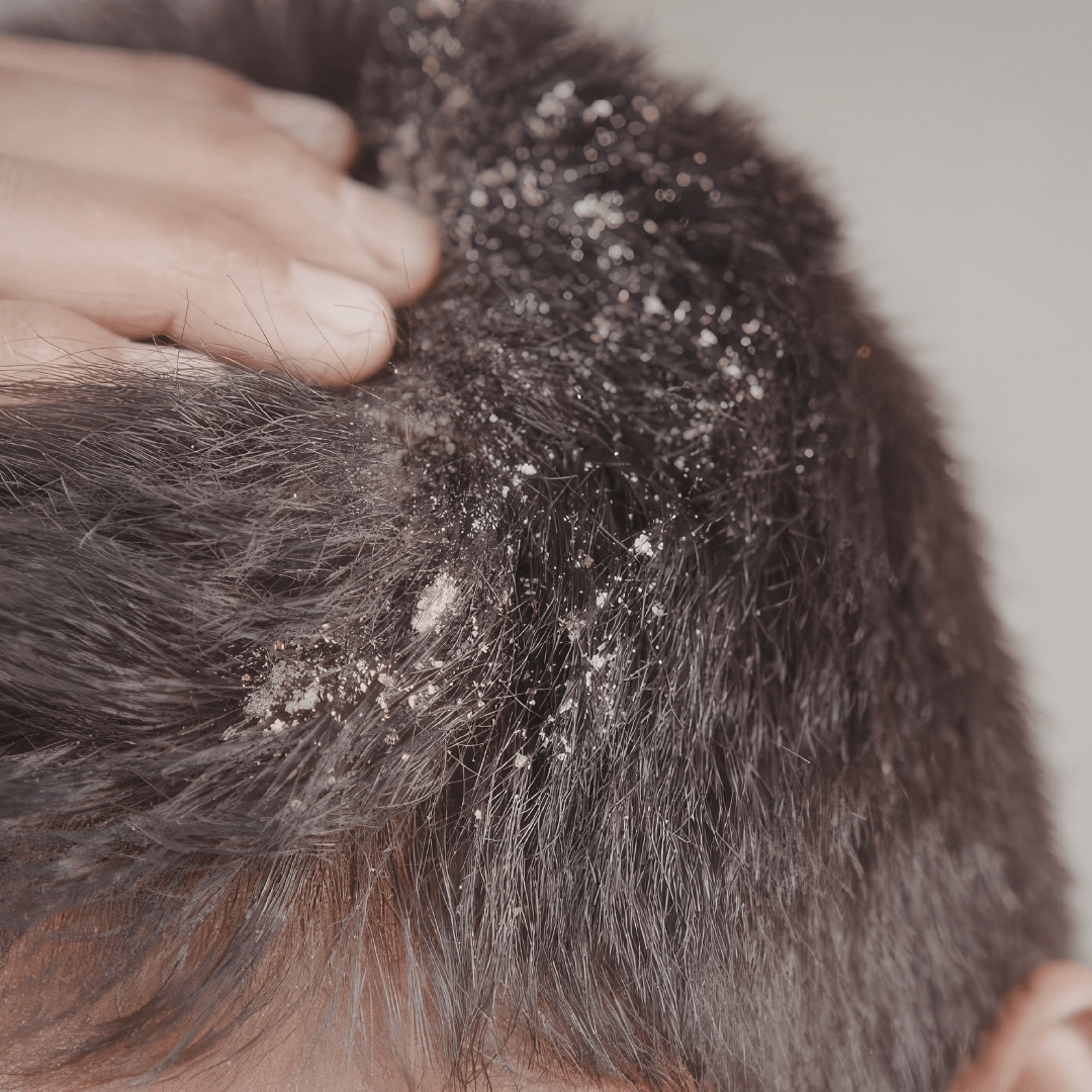 Cuir chevelu qui démange : 8 remèdes naturels efficaces