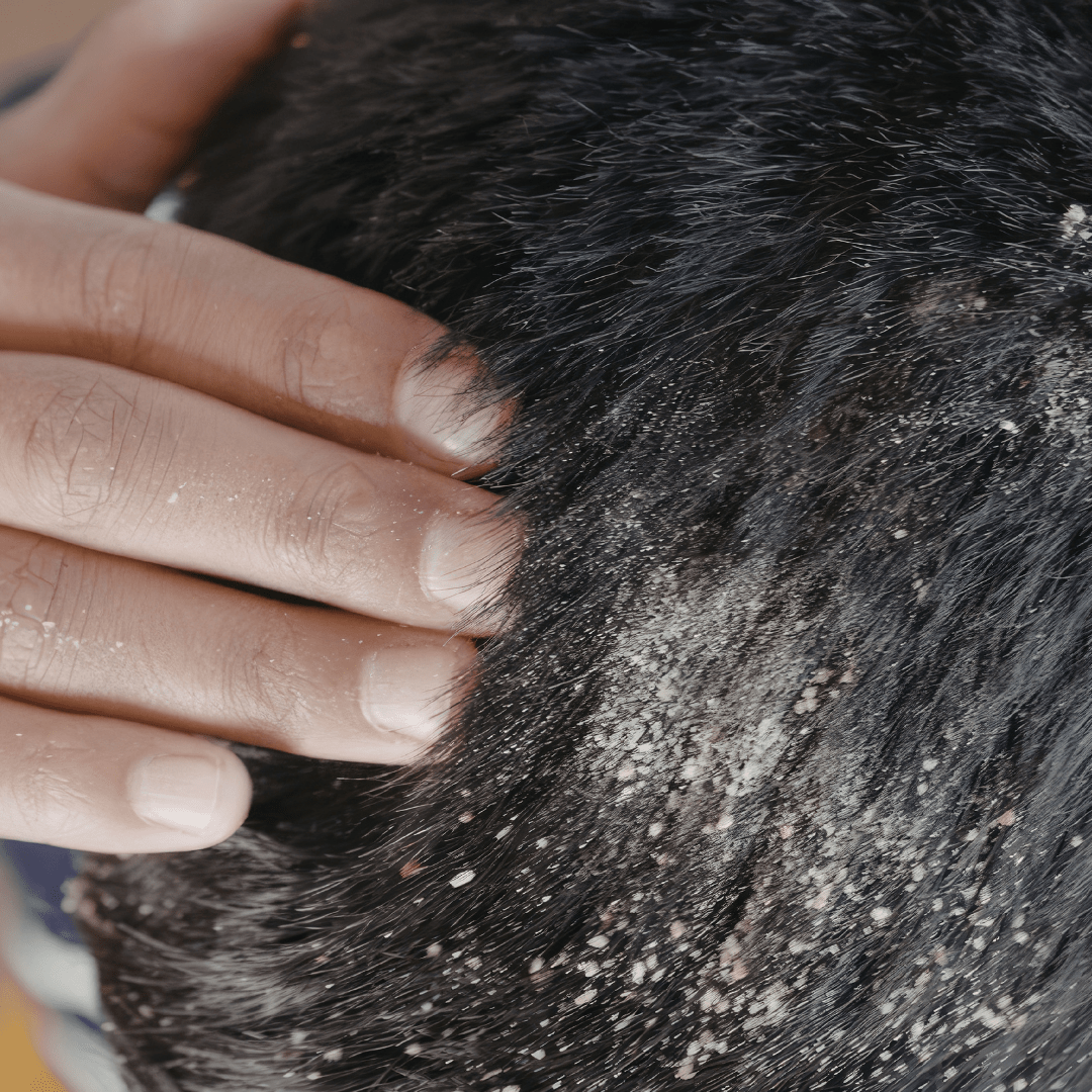 pellicules-sèches-traitement-naturel