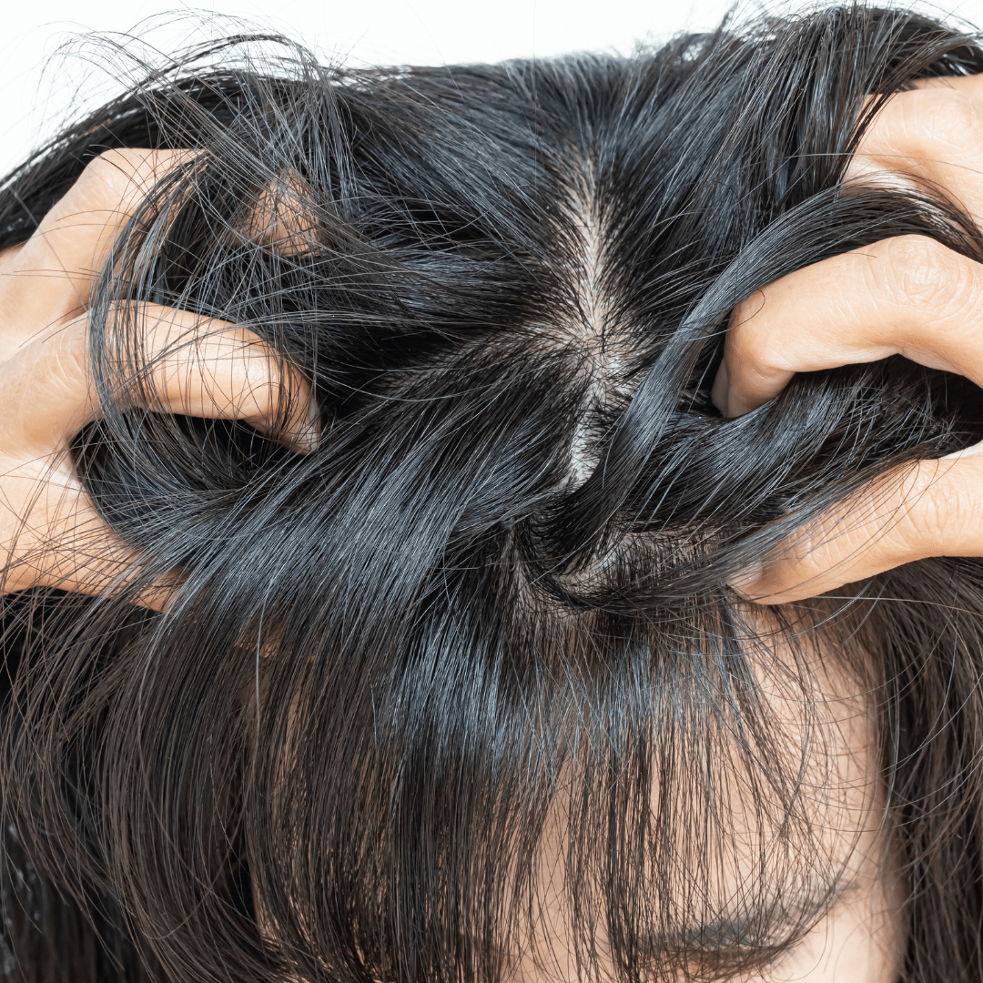 Cuir chevelu sec : que faire ? 10 solutions naturelles qui marchent