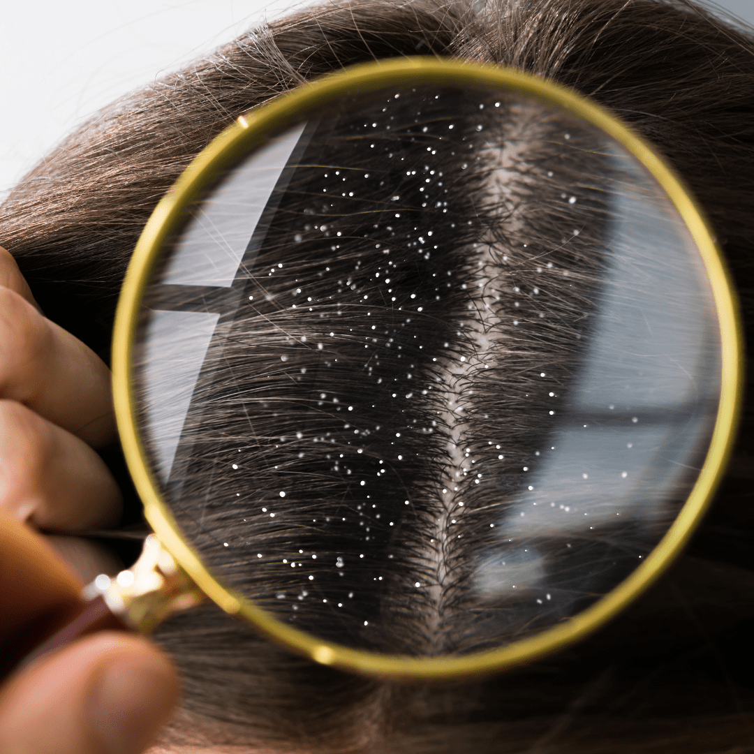 quelle-est-la-cause-des-pellicules – zoom-sur-cuir-chevelu-avec-pellicules – observation-des-squames-capillaires – cuir-chevelu-irrité