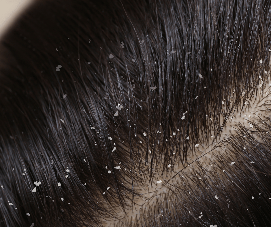 cheveux-pellicule